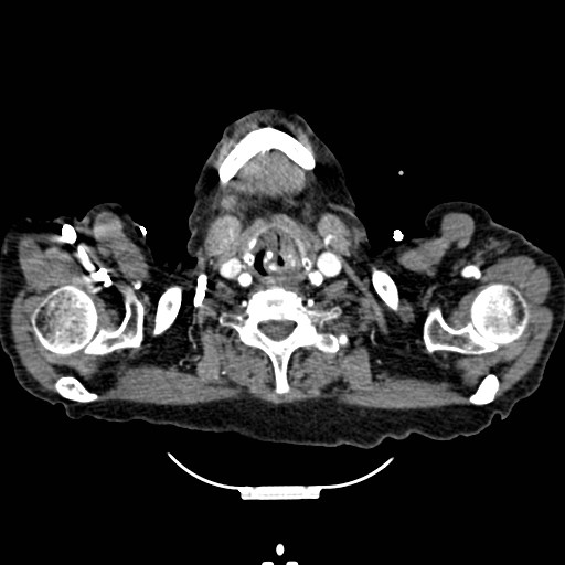 File:Aorto-esophageal fistula (Radiopaedia 49648).jpg