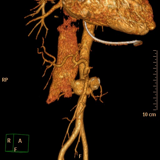 File:Aorto-left renal vein fistula (Radiopaedia 45534-49628 D 7).jpg