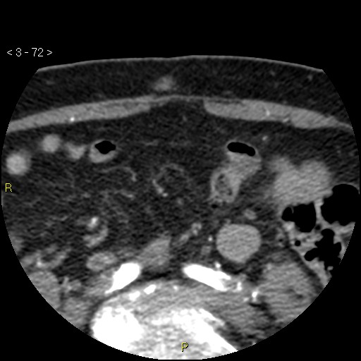 Aortoiliac occlusive disease (Radiopaedia 16828-16548 A 72).jpg