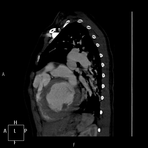 File:Aortopulmonary septal defect (Radiopaedia 41990-45013 Sagittal C+ CTPA 12).jpg