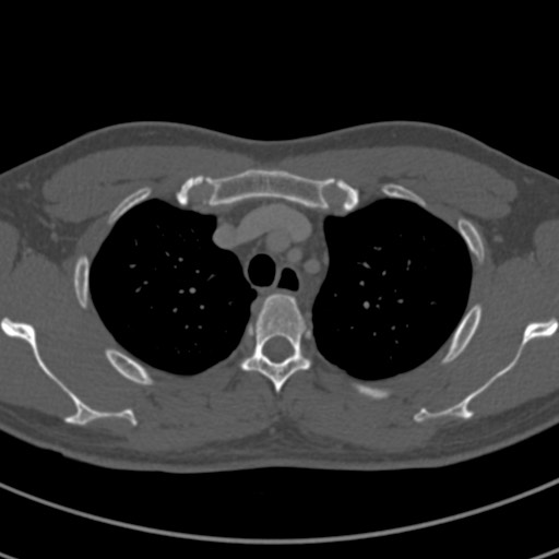 Apical lung mass mimic - neurogenic tumor (Radiopaedia 59918-67521 Axial bone window 19).jpg