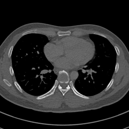 Apical lung mass mimic - neurogenic tumor (Radiopaedia 59918-67521 Axial bone window 50).jpg