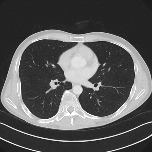 Apical pleural calcification (Radiopaedia 46141-50499 Axial lung window 38).png
