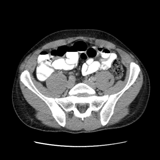 File:Appendicitis complicated by post-operative collection (Radiopaedia 35595-37113 A 53).jpg