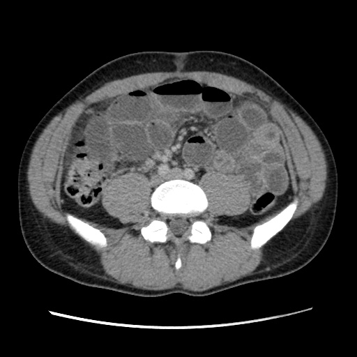 Appendicitis complicated by post-operative collection (Radiopaedia 35595-37114 A 53).jpg