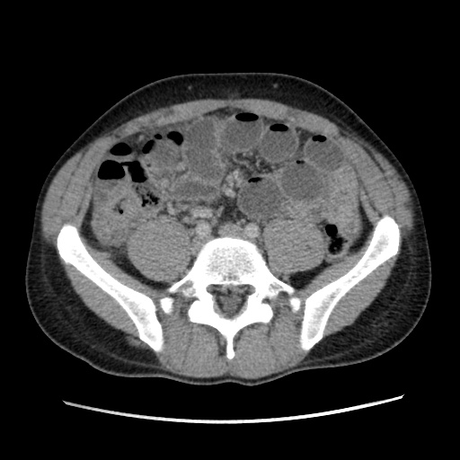 File:Appendicitis complicated by post-operative collection (Radiopaedia 35595-37114 A 57).jpg