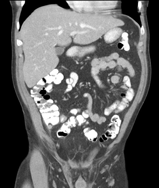 Appendicitis with cecal bar sign (Radiopaedia 31878-32830 A 24).jpg