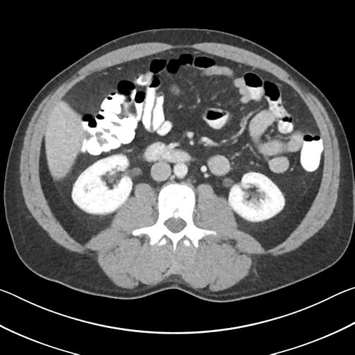 File:Appendicitis with cecal bar sign (Radiopaedia 31878-32830 B 39).jpg