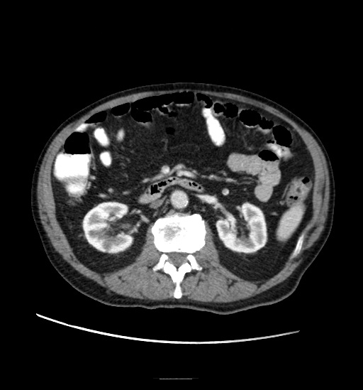 Appendicitis with localized perforation and abscess formation (Radiopaedia 49035-54130 A 41).jpg