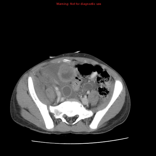 File:Appendicitis with phlegmon (Radiopaedia 9358-10046 A 53).jpg