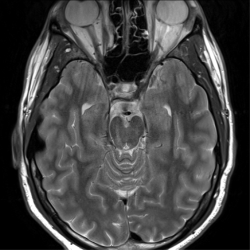 File:Arachnoid cyst - cerebellopontine angle (Radiopaedia 59689-67083 Axial T2 20).png
