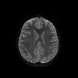 Arachnoid cyst - middle cranial fossa (Radiopaedia 67671-77088 Axial DWI 45).jpg