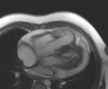 Arrhythmogenic right ventricular cardiomyopathy (Radiopaedia 69431-79307 4ch cine 65).jpg
