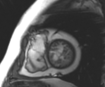 File:Arrhythmogenic right ventricular cardiomyopathy (Radiopaedia 69431-79307 Short axis cine 45).jpg