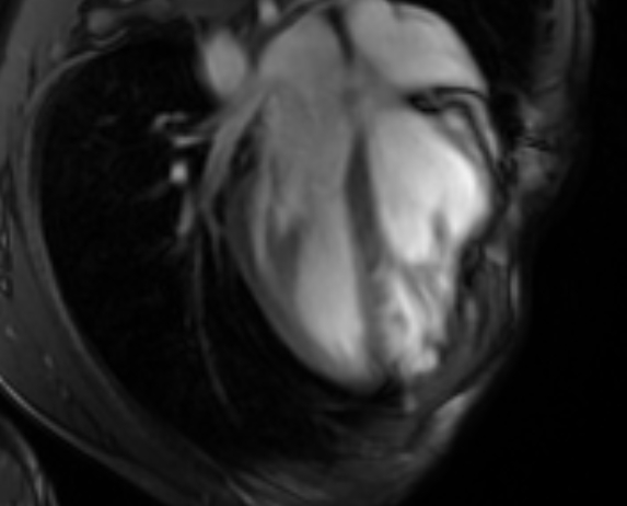Arrhythmogenic right ventricular cardiomyopathy (Radiopaedia 69564-79464 4ch cine 50).jpg
