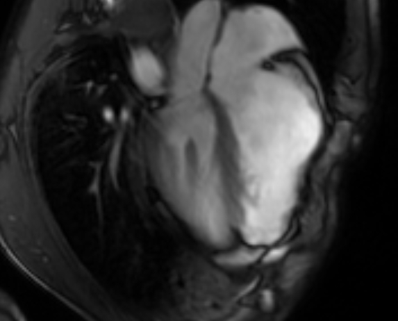 File:Arrhythmogenic right ventricular cardiomyopathy (Radiopaedia 69564-79464 4ch cine 85).jpg