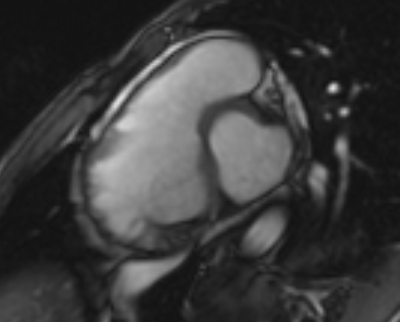 Arrhythmogenic right ventricular cardiomyopathy (Radiopaedia 69564-79464 short axis cine 223).jpg