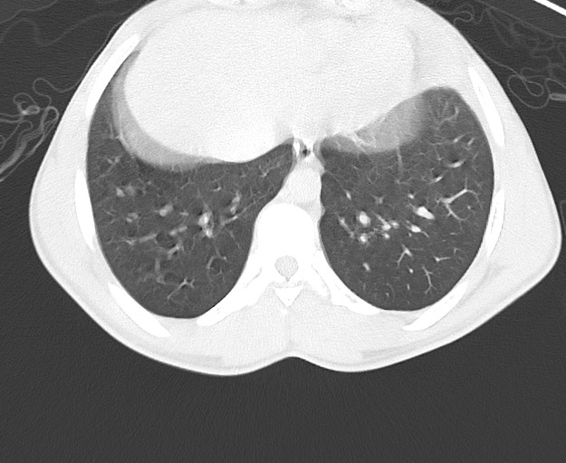 File:Arrow injury to the chest (Radiopaedia 75223-86321 Axial lung window 72).jpg