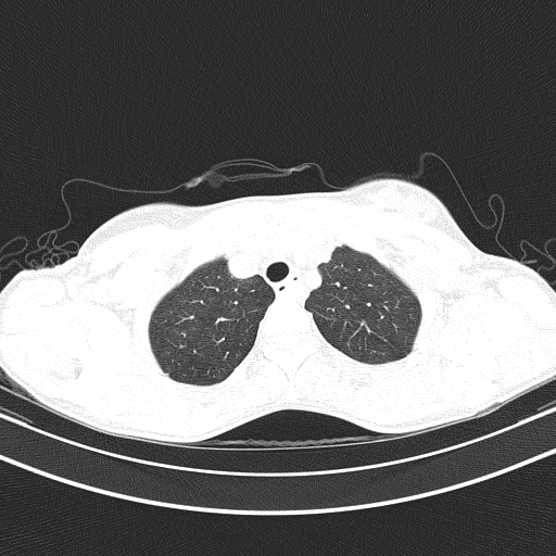 File:Arteria lusoria (Radiopaedia 88528-105192 Axial lung window 15).jpg
