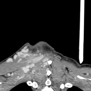 Arteriovenous malformation of the neck (Radiopaedia 53935-60062 D 64).jpg