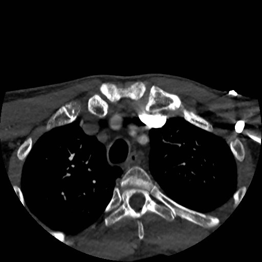 Artery of Percheron infarct (Radiopaedia 48088-52894 A 13).jpg