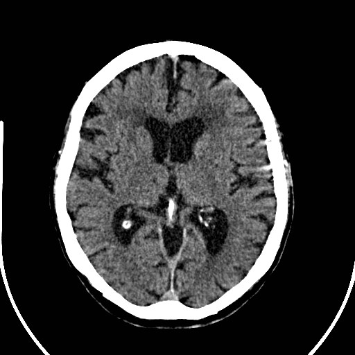 File:Artery of Percheron infarction (Radiopaedia 26307-26438 Axial non-contrast 21).jpg