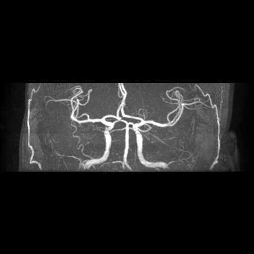 Artery of Percheron infarction (Radiopaedia 27975-28230 3D TOF 10).jpg