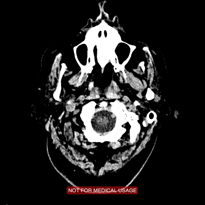 Artery of Percheron infarction (Radiopaedia 28679-28967 Axial non-contrast 5).jpg