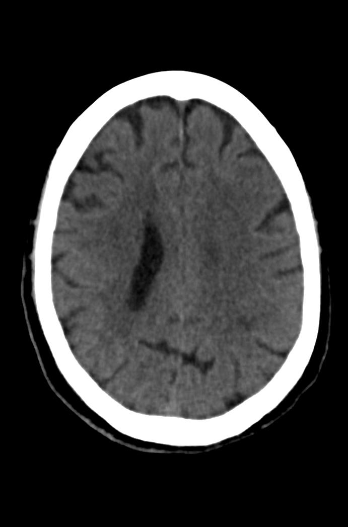 Artery of Percheron infarction (Radiopaedia 80613-94202 Axial non-contrast 127).jpg