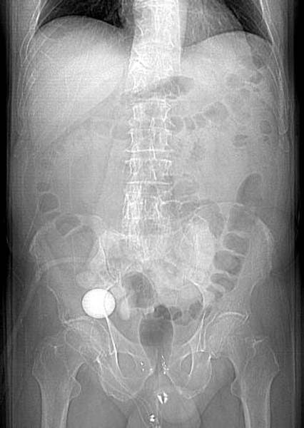 File:Artificial urethral sphincter (Radiopaedia 11211-11575 None 1).jpg