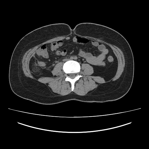 File:Ascending retrocecal appendicitis with liver abscesses (Radiopaedia 60066-67615 Axial non-contrast 50).jpg