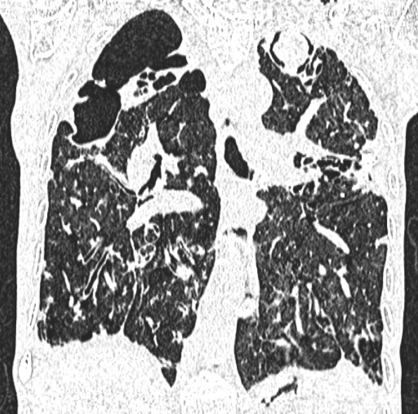 Aspergilloma- with Monod sign (Radiopaedia 44737-48532 Coronal lung window 268).jpg