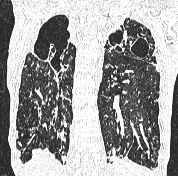 Aspergilloma- with Monod sign (Radiopaedia 44737-48532 Coronal lung window 336).jpg