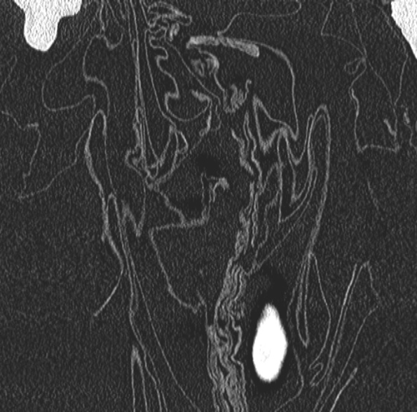 Aspergilloma- with Monod sign (Radiopaedia 44737-48532 Coronal lung window 96).jpg