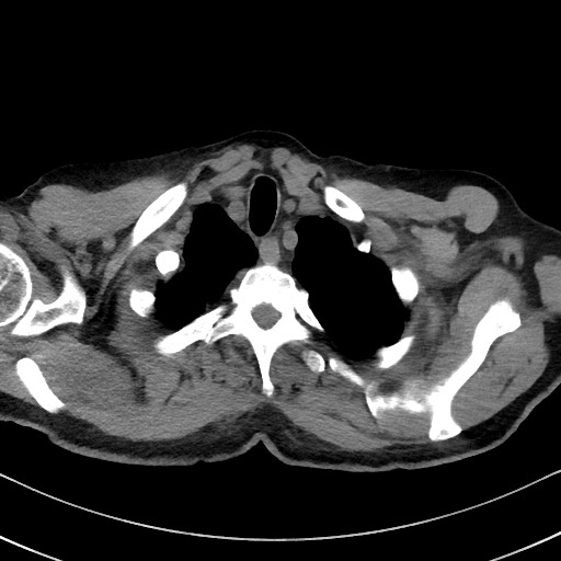 Aspergilloma on background pulmonary fibrosis (Radiopaedia 60942-68757 Axial non-contrast 8).jpg