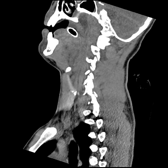 File:Atlanto-occipital dissociation (Traynelis type 1), C2 teardrop fracture, C6-7 facet joint dislocation (Radiopaedia 87655-104061 D 35).jpg