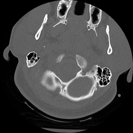 Atlanto-occipital dissociation injury (Radiopaedia 29274-29698 Axial bone window 9).png