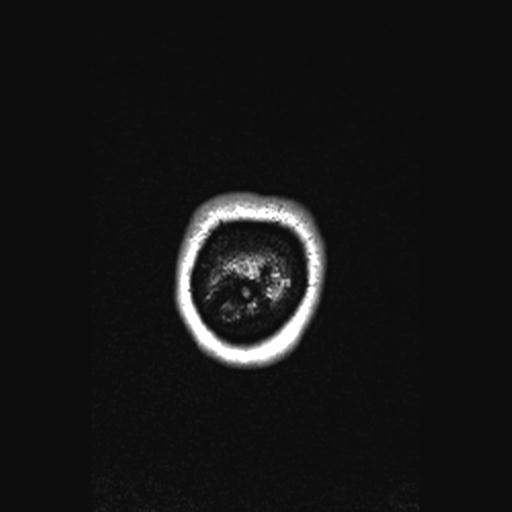 Atretic encephalocoele with inferior vermis hypoplasia (Radiopaedia 30443-31108 Coronal FLAIR 10).jpg
