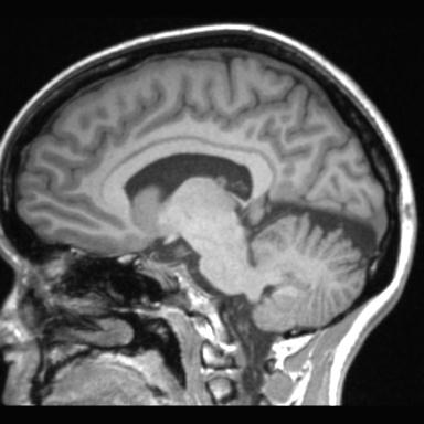 Atretic encephalocoele with inferior vermis hypoplasia (Radiopaedia 30443-31108 Sagittal T1 58).jpg