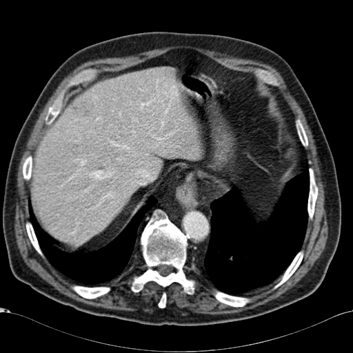 Atypical hepatocellular carcinoma (Radiopaedia 41744-44698 B 14).jpg