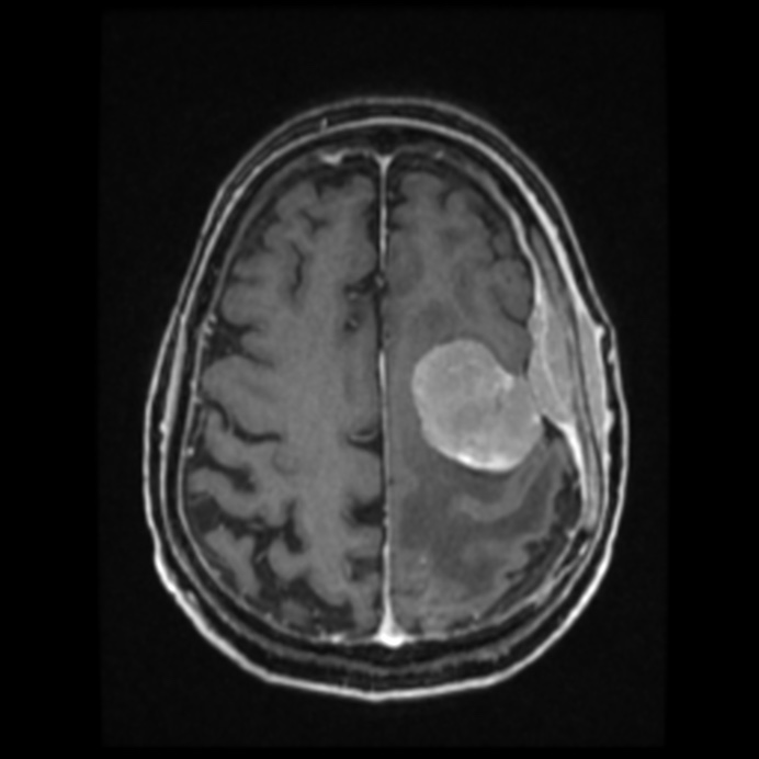 Atypical meningioma (Radiopaedia 45535-49629 Axial T1 C+ 51).jpg