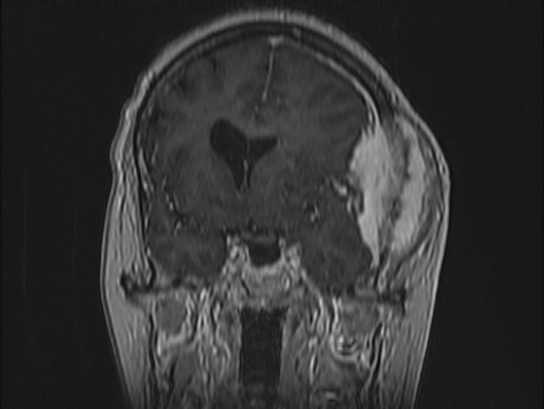 Atypical meningioma (Radiopaedia 62985-71406 Coronal T1 C+ 43).jpg