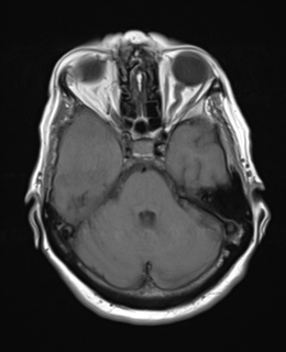 File:Atypical meningioma (WHO Grade II) (Radiopaedia 54742-60979 Axial T1 8).png