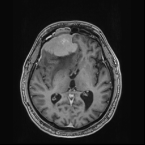 Atypical meningioma (WHO grade II) with brain invasion (Radiopaedia 57767-64729 Axial T1 C+ 24).png