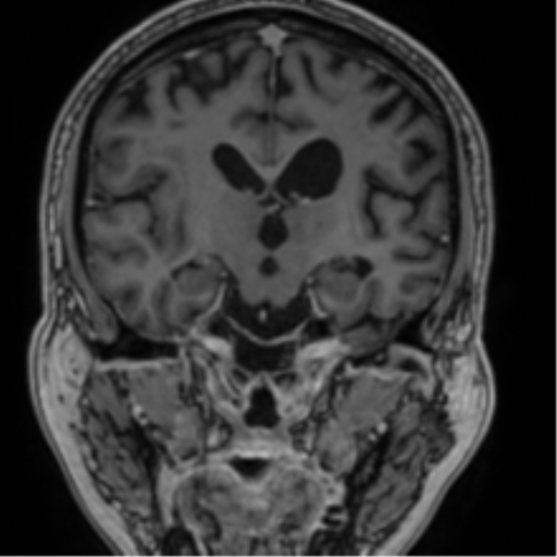 Atypical meningioma (WHO grade II) with brain invasion (Radiopaedia 57767-64729 Coronal T1 C+ 44).png