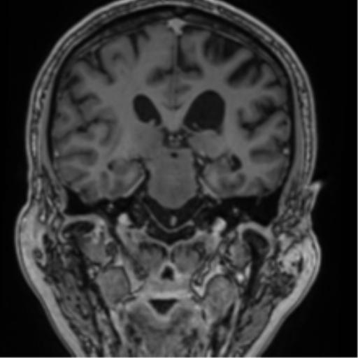 File:Atypical meningioma (WHO grade II) with brain invasion (Radiopaedia 57767-64729 Coronal T1 C+ 48).png