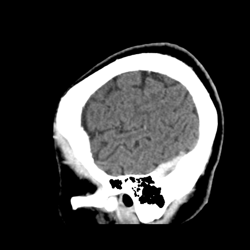 Atypical meningioma (WHO grade II) with osseous invasion (Radiopaedia 53654-59715 G 46).png