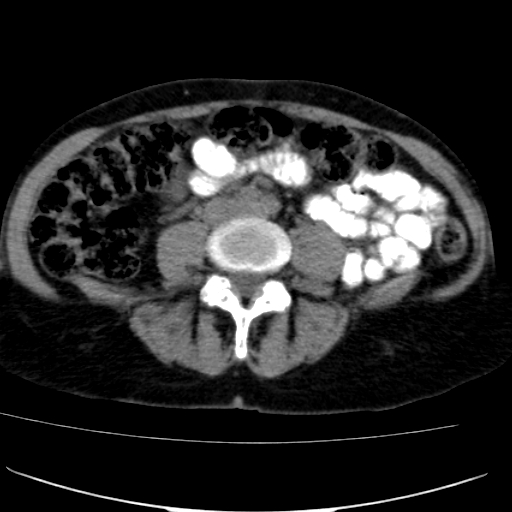 File:Atypical renal cyst (Radiopaedia 17536-17251 non-contrast 30).jpg