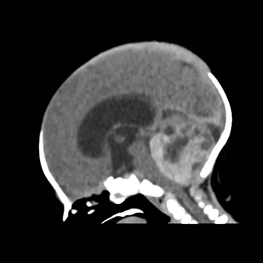 File:Atypical teratoid rhabdoid tumor (prenatal US and neonatal MRI) (Radiopaedia 59091-66387 B 1).jpg