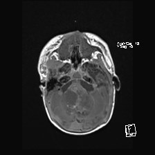 Atypical teratoid rhabdoid tumor (prenatal US and neonatal MRI) (Radiopaedia 59091-66388 Axial T1 16).jpg